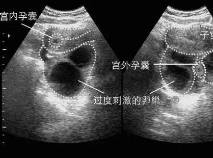 2026北京第三代试管婴儿哪家医院做的比较好？